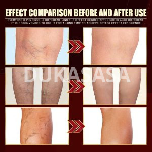 Varicose Vein Treatment Spray
